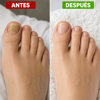 MYCONAIL PATCH™ | RECUPERA LA APARIENCIA SALUDABLE DE TUS UÑAS.